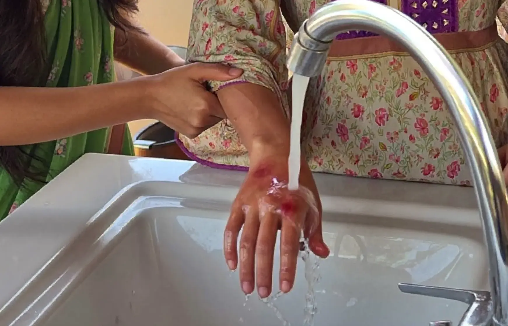 Acid Attack First Aid: What to Do in the First 24 Hours